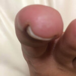 現在巻き爪治療は行ってはいない