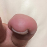 20代女性の巻き爪