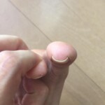 現在病院で治療中の巻き爪