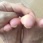 病院では化膿予防の抗生物質を出された