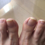 30代女性の巻き爪