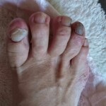 60代女性の巻き爪