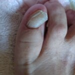 斜めに生えた巻き爪の写真