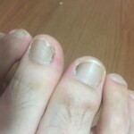 病院で巻き爪との診断