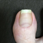 クラシックバレエの影響で巻き爪に