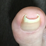 かなり皮膚に食い込んでいる巻き爪