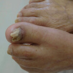 ヒルドイドローションを1日2回注入する治療法を受けている