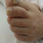 88歳女性の巻き爪