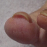 皮膚科以外で巻き爪治療