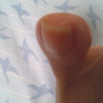 根元からの治療が必要なタイプの巻き爪だった