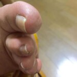 50代女性の巻き爪