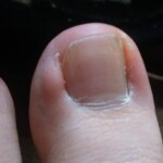 幼少期より巻き爪