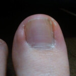 20代女性の巻き爪