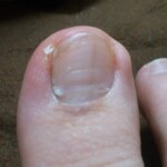 使用していた靴が小さかったため巻き爪に